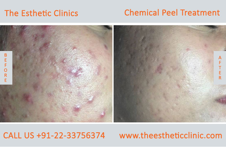 Chemical Peels Treatment before after photos in mumbai india (5)